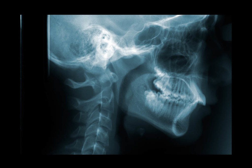 X-ray of the cervical spine
